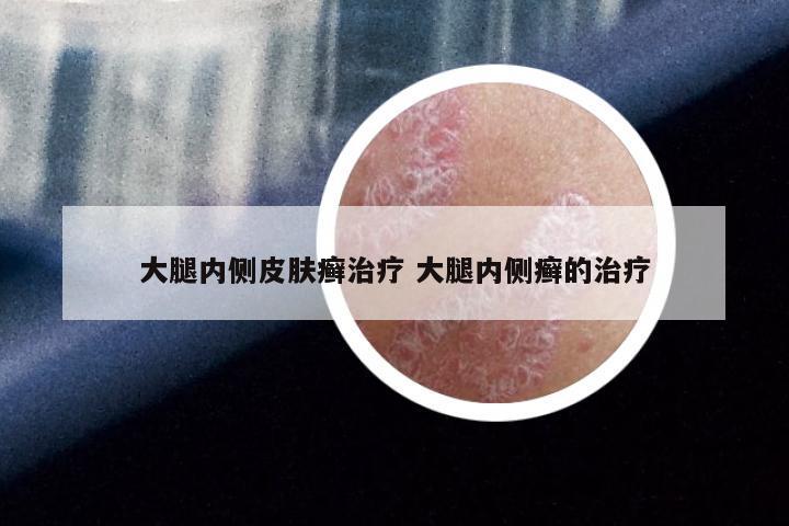 大腿内侧皮肤癣治疗 大腿内侧癣的治疗