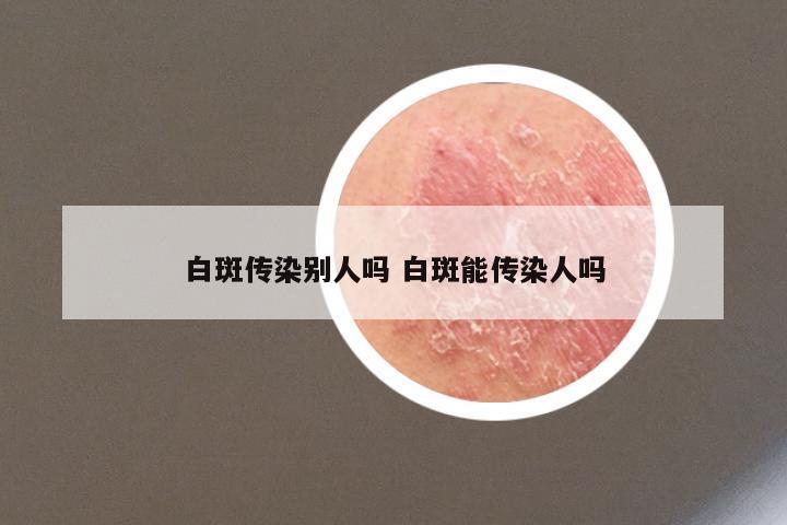 白斑传染别人吗 白斑能传染人吗