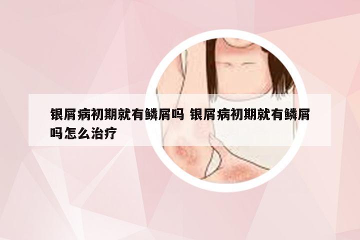 银屑病初期就有鳞屑吗 银屑病初期就有鳞屑吗怎么治疗