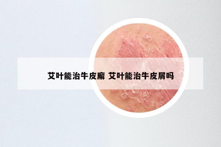 艾叶能治牛皮廨 艾叶能治牛皮屑吗