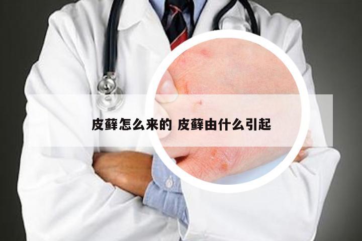 皮藓怎么来的 皮藓由什么引起