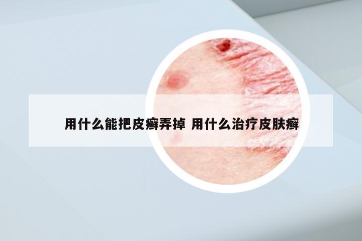 用什么能把皮癣弄掉 用什么治疗皮肤癣