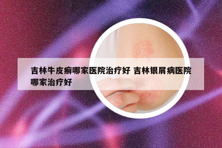 吉林牛皮癣哪家医院治疗好 吉林银屑病医院哪家治疗好