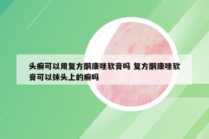 头癣可以用复方酮康唑软膏吗 复方酮康唑软膏可以抹头上的癣吗