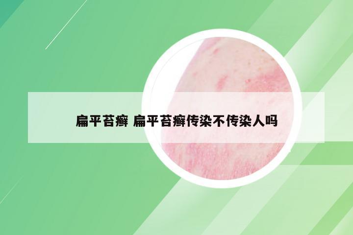 扁平苔癣 扁平苔癣传染不传染人吗