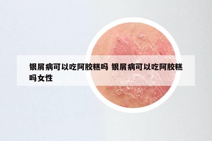 银屑病可以吃阿胶糕吗 银屑病可以吃阿胶糕吗女性