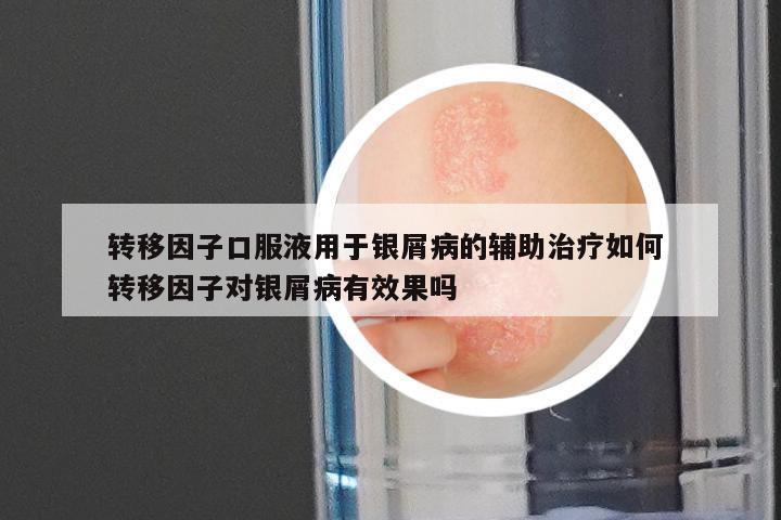 转移因子口服液用于银屑病的辅助治疗如何 转移因子对银屑病有效果吗