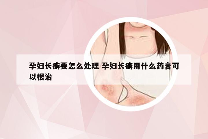 孕妇长癣要怎么处理 孕妇长癣用什么药膏可以根治