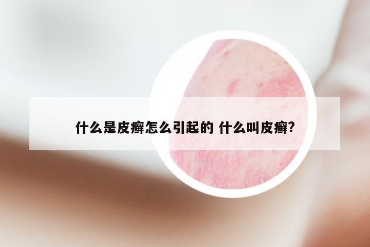 什么是皮癣怎么引起的 什么叫皮癣?