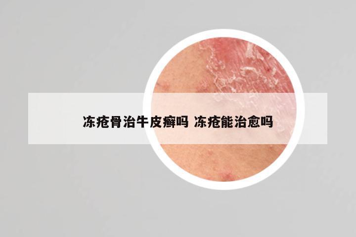 冻疮骨治牛皮癣吗 冻疮能治愈吗