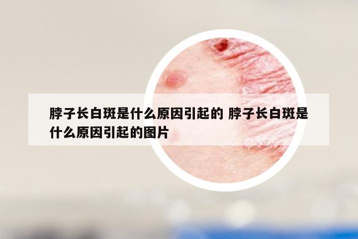 脖子长白斑是什么原因引起的 脖子长白斑是什么原因引起的图片