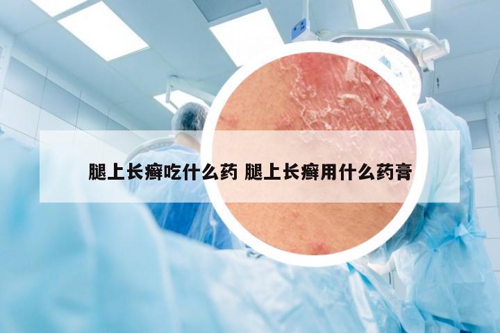 腿上长癣吃什么药 腿上长癣用什么药膏