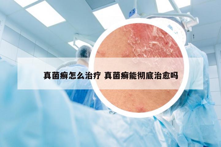 真菌癣怎么治疗 真菌癣能彻底治愈吗