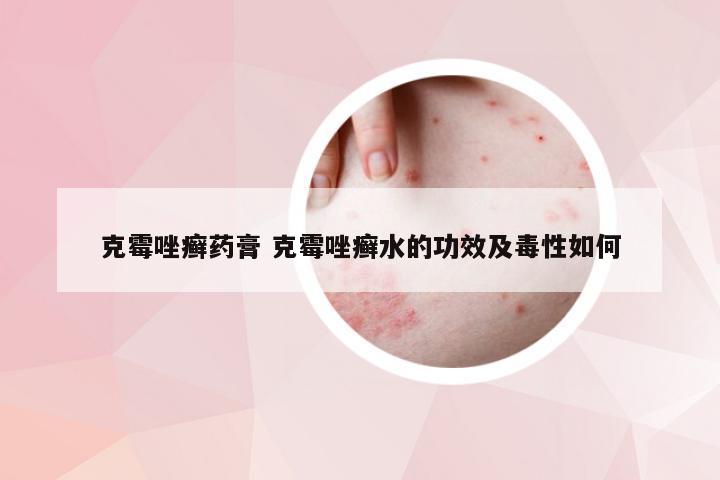 克霉唑癣药膏 克霉唑癣水的功效及毒性如何