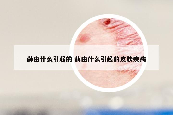 藓由什么引起的 藓由什么引起的皮肤疾病