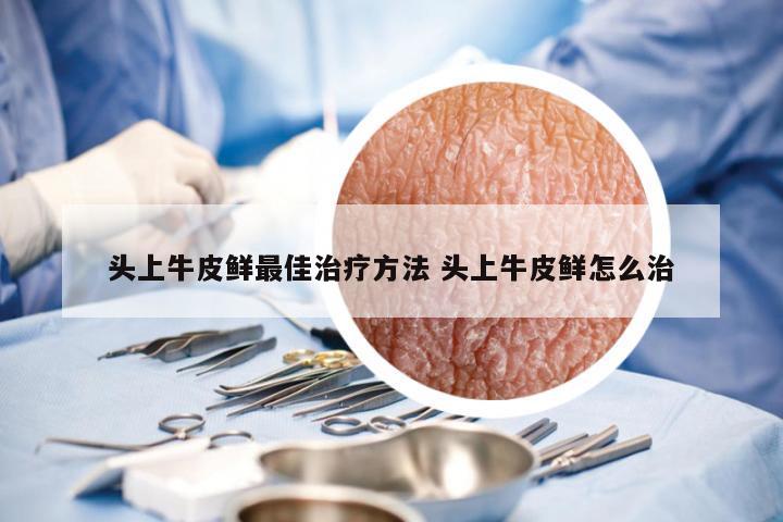 头上牛皮鲜最佳治疗方法 头上牛皮鲜怎么治