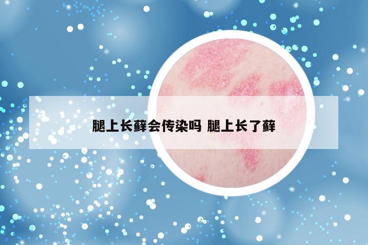 腿上长藓会传染吗 腿上长了藓