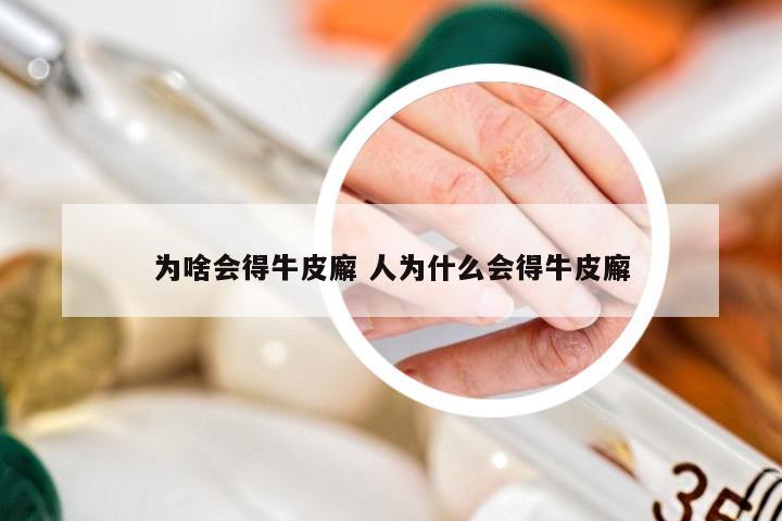 为啥会得牛皮廨 人为什么会得牛皮廨