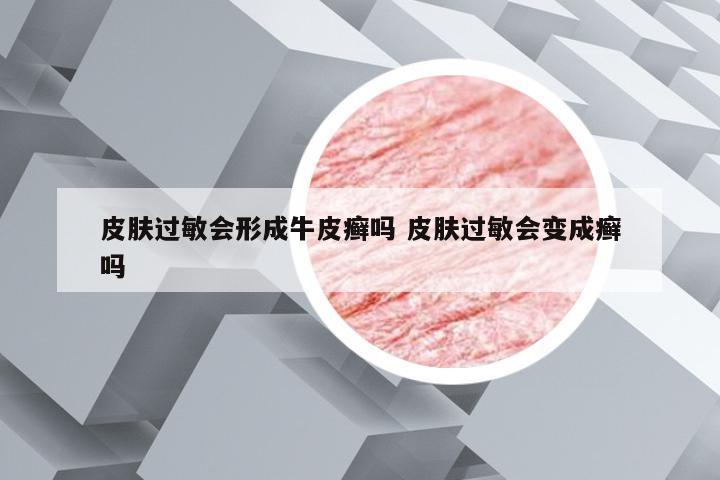 皮肤过敏会形成牛皮癣吗 皮肤过敏会变成癣吗