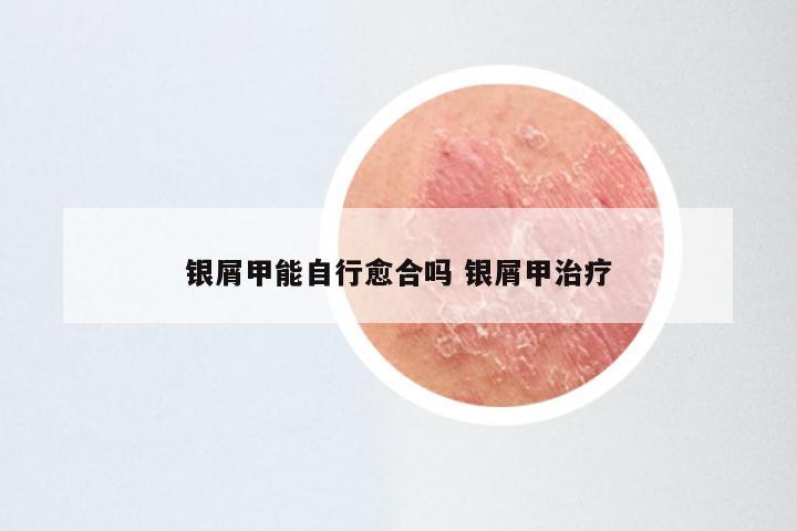 银屑甲能自行愈合吗 银屑甲治疗