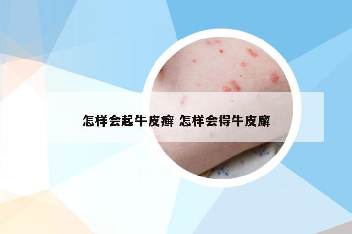 怎样会起牛皮癣 怎样会得牛皮廨