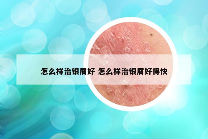 怎么样治银屑好 怎么样治银屑好得快