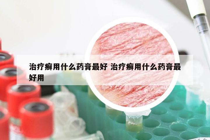 治疗癣用什么药膏最好 治疗癣用什么药膏最好用