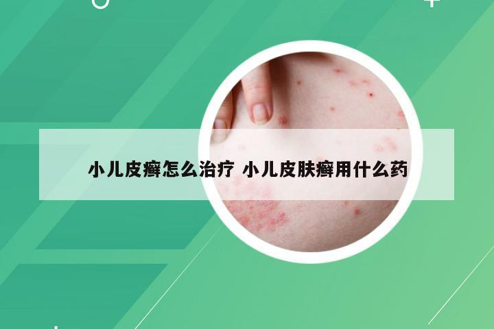 小儿皮癣怎么治疗 小儿皮肤癣用什么药