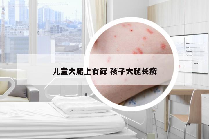 儿童大腿上有藓 孩子大腿长癣