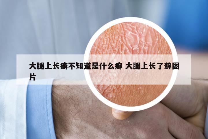 大腿上长癣不知道是什么癣 大腿上长了藓图片