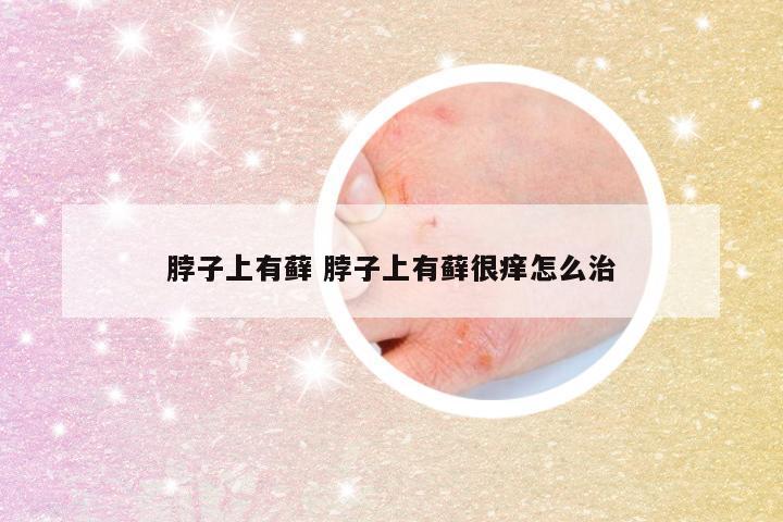 脖子上有藓 脖子上有藓很痒怎么治