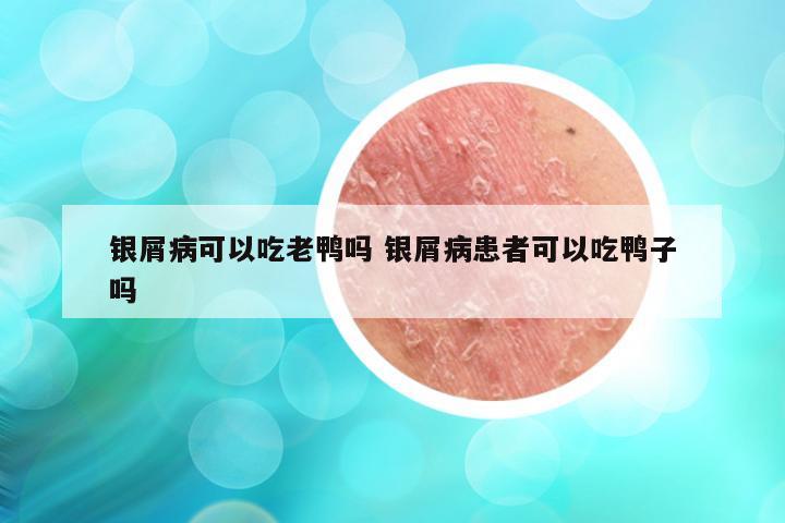 银屑病可以吃老鸭吗 银屑病患者可以吃鸭子吗