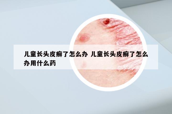 儿童长头皮癣了怎么办 儿童长头皮癣了怎么办用什么药