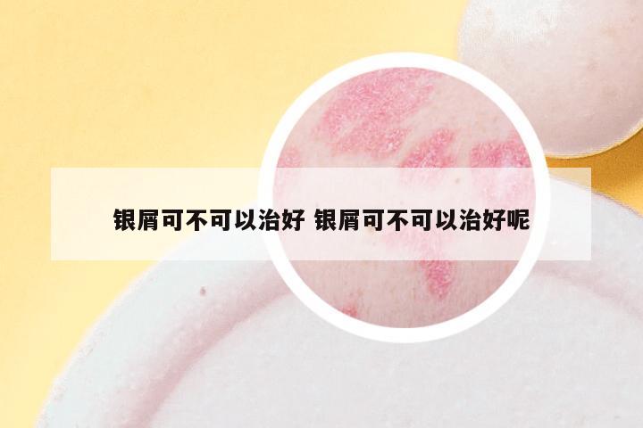 银屑可不可以治好 银屑可不可以治好呢