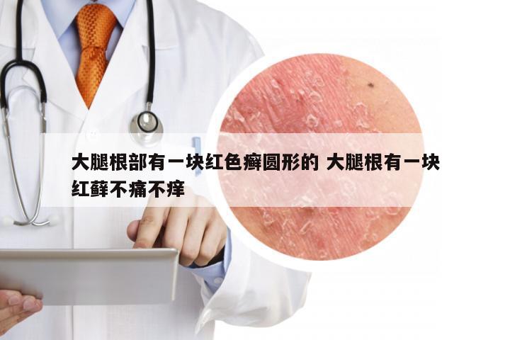 大腿根部有一块红色癣圆形的 大腿根有一块红藓不痛不痒