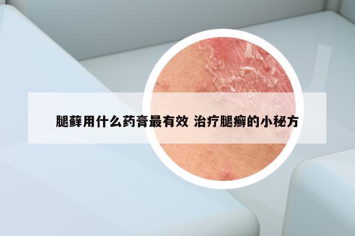 腿藓用什么药膏最有效 治疗腿癣的小秘方