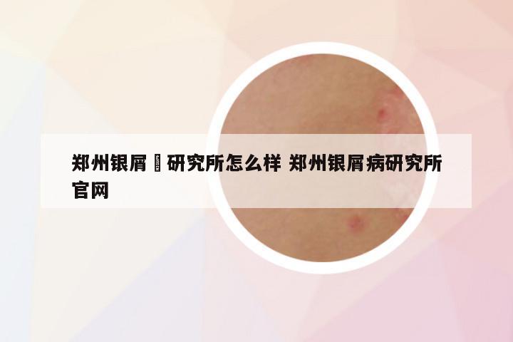 郑州银屑怲研究所怎么样 郑州银屑病研究所官网