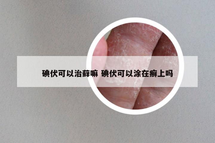 碘伏可以治藓嘛 碘伏可以涂在癣上吗