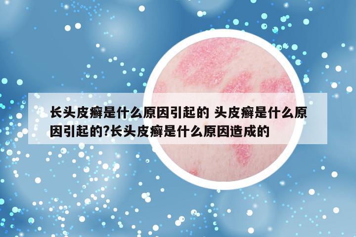 长头皮癣是什么原因引起的 头皮癣是什么原因引起的?长头皮癣是什么原因造成的