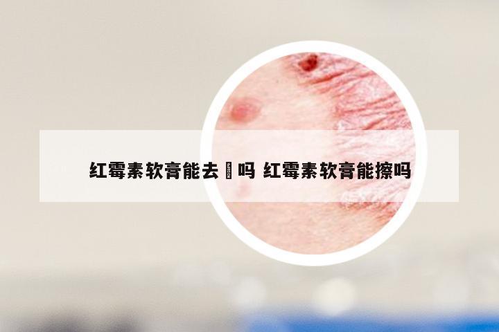 红霉素软膏能去廯吗 红霉素软膏能擦吗