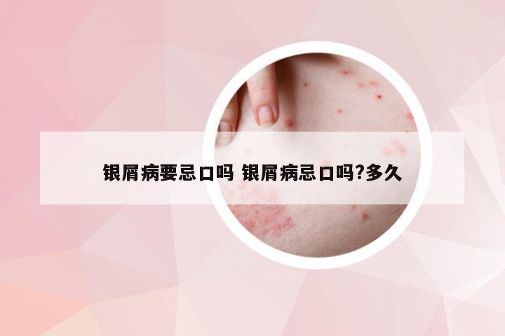 银屑病要忌口吗 银屑病忌口吗?多久