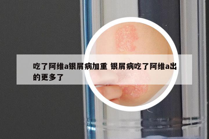 吃了阿维a银屑病加重 银屑病吃了阿维a出的更多了