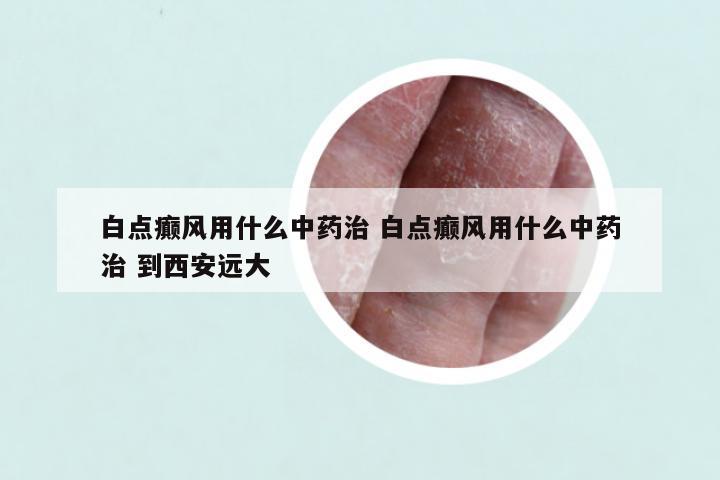 白点癫风用什么中药治 白点癫风用什么中药治 到西安远大