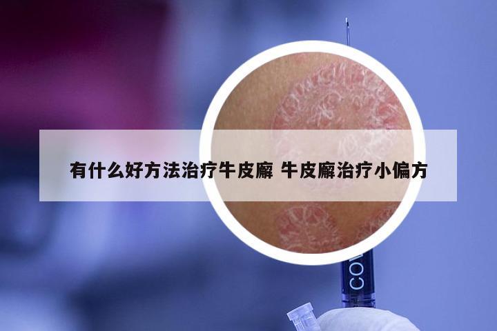 有什么好方法治疗牛皮廨 牛皮廨治疗小偏方