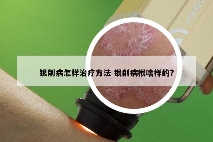 银削病怎样治疗方法 银削病根啥样的?