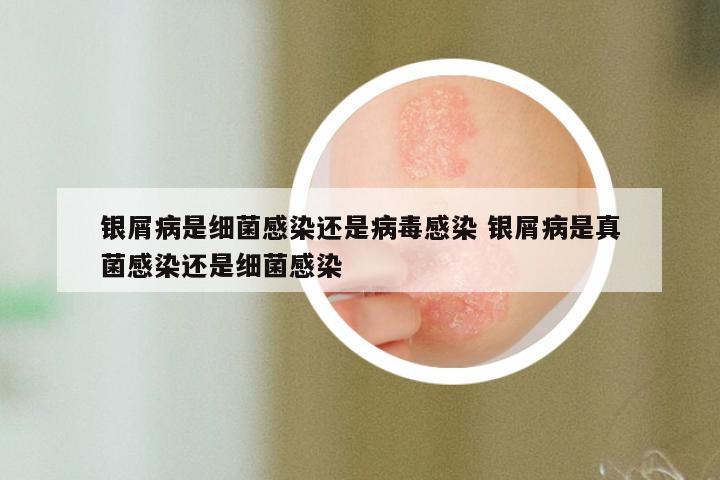 银屑病是细菌感染还是病毒感染 银屑病是真菌感染还是细菌感染