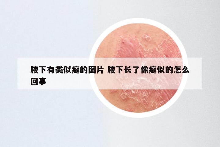 腋下有类似癣的图片 腋下长了像癣似的怎么回事