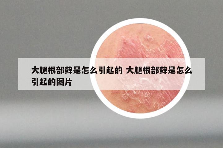 大腿根部藓是怎么引起的 大腿根部藓是怎么引起的图片