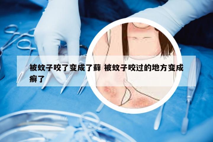 被蚊子咬了变成了藓 被蚊子咬过的地方变成癣了