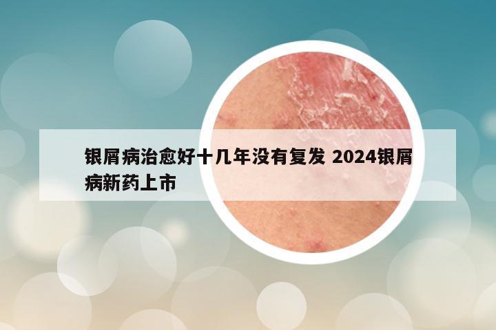 银屑病治愈好十几年没有复发 2024银屑病新药上市